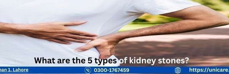 What are the 5 types of kidney stones?